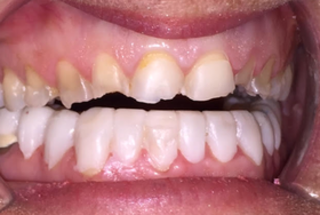 Smile Makeovers: Case 17 - Before
