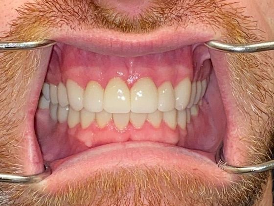 Dental Crowns Case 1 - After