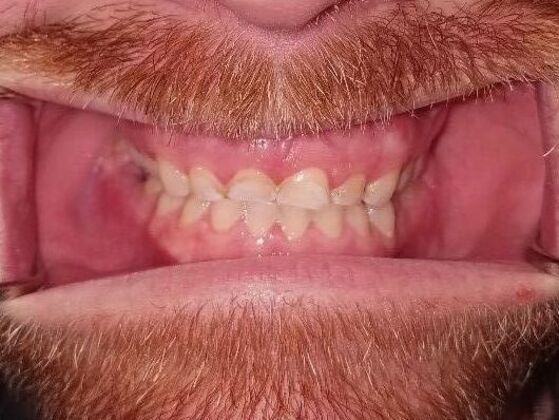 Dental Crowns Case 1 - Before