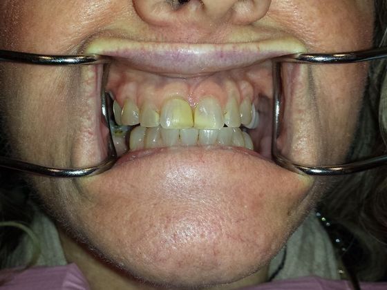 Porcelain Veneers Case 1 - Before