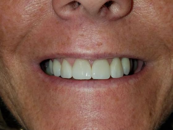 Porcelain Veneers Case 1 - After