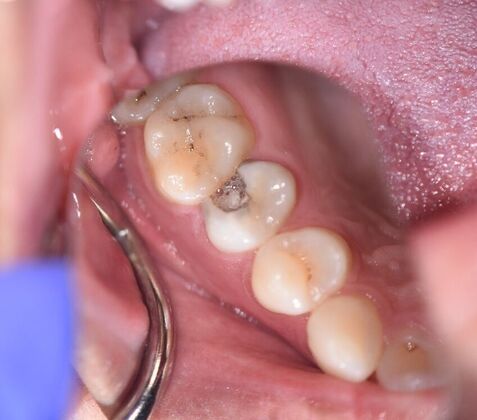 Crowns Case 24 - Victoria, TX - Before