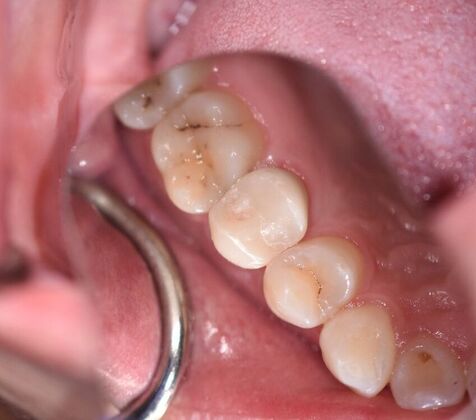 Crowns Case 24 - Victoria, TX - After