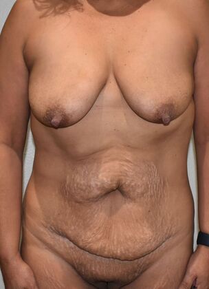 Mommy Makeover Case 230 - Before