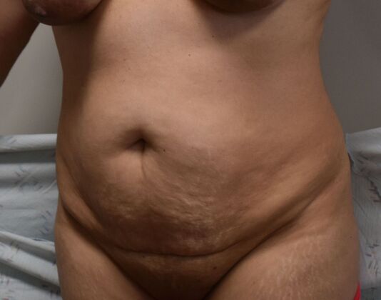Tummy Tuck (Abdominoplasty): Case 349 - Before