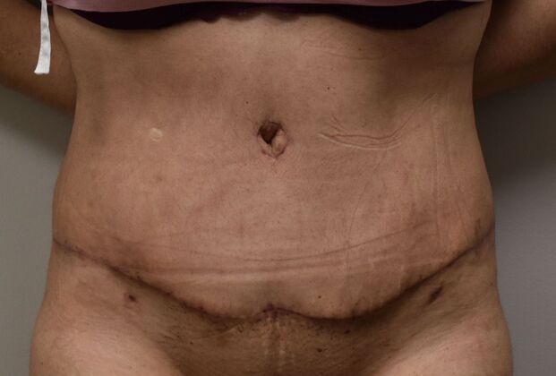 Tummy Tuck (Abdominoplasty): Case 349 - After
