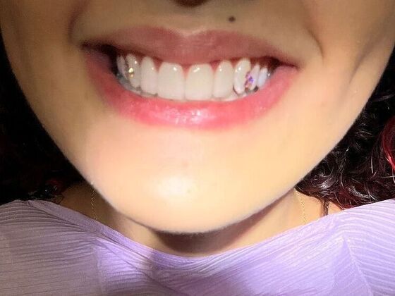 Tooth Gems Tooth Gems - Smile with sparkle! - After