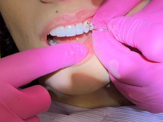 Tooth Gems Tooth Gems - Smile with sparkle! - Before