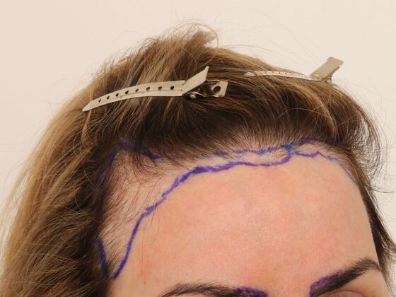 Hair Transplant - Female: Hairline FUT (4) - Before hair transplant