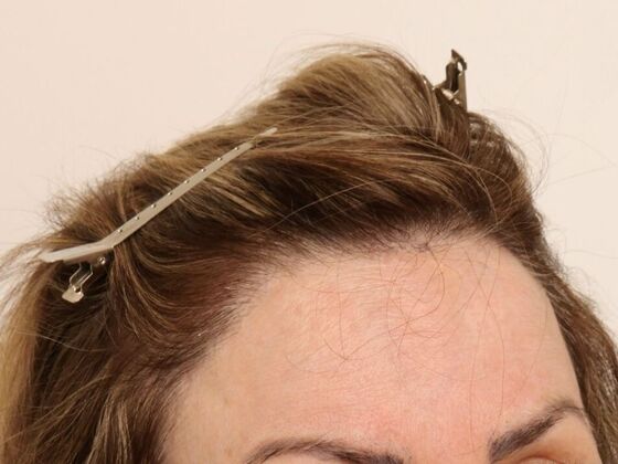 Hair Transplant - Female: Hairline FUT (4) - After female hair transpalnt