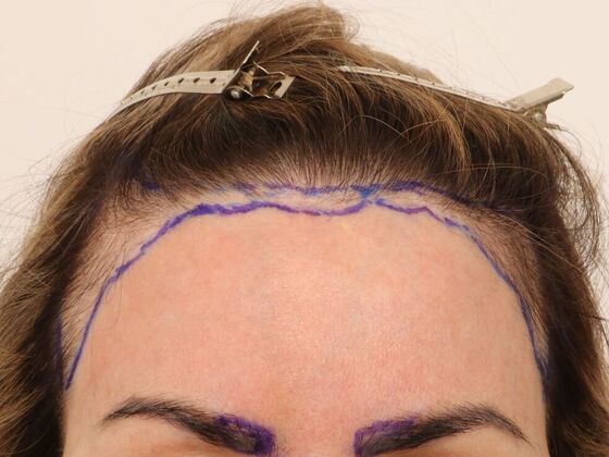 Hair Transplant - Female: Hairline FUT (4) - Before hair transplant