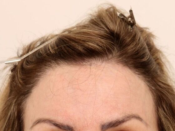 Hair Transplant - Female: Hairline FUT (4) - After female hair transpalnt