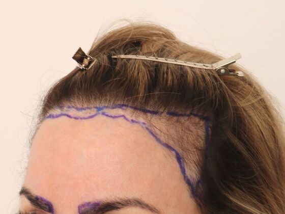 Hair Transplant - Female: Hairline FUT (4) - Before hair transplant