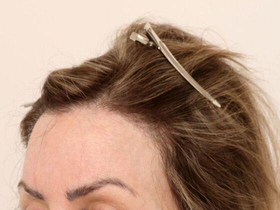 Hair Transplant - Female: Hairline FUT (4) - After female hair transpalnt