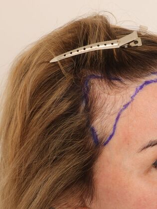 Hair Transplant - Female: Hairline FUT (4) - Before hair transplant