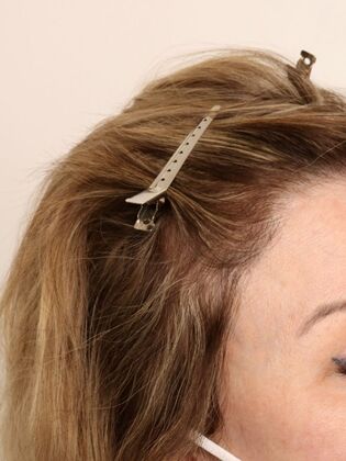 Hair Transplant - Female: Hairline FUT (4) - After female hair transpalnt