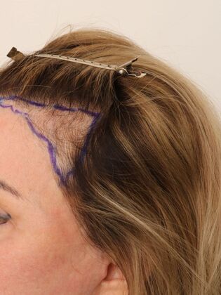 Hair Transplant - Female: Hairline FUT (4) - Before hair transplant