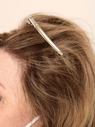 Hair Transplant - Female: Hairline FUT (4) - After female hair transpalnt