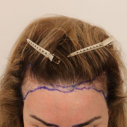 Hair Transplant - Female: Hairline FUT (4) - Before hair transplant