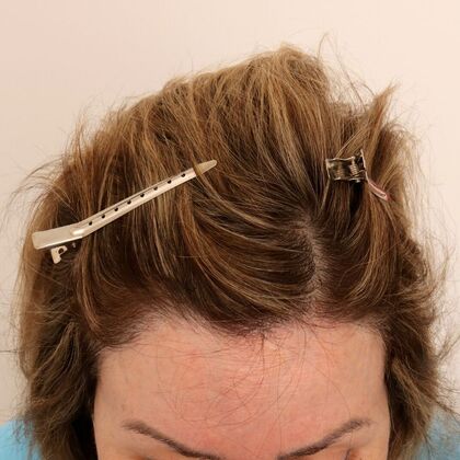 Hair Transplant - Female: Hairline FUT (4) - After female hair transpalnt