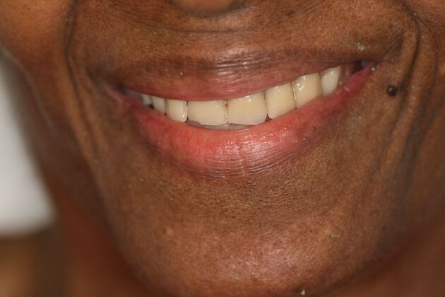 Implant supported Fixed Hybrid Overdenture Case 1 - Before