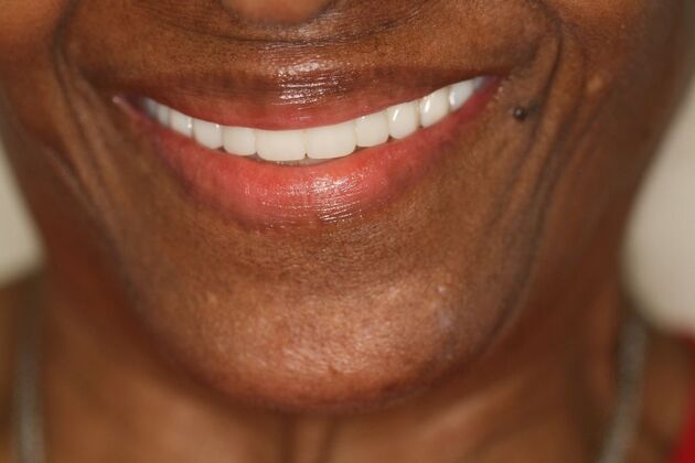 Implant supported Fixed Hybrid Overdenture Case 1 - After