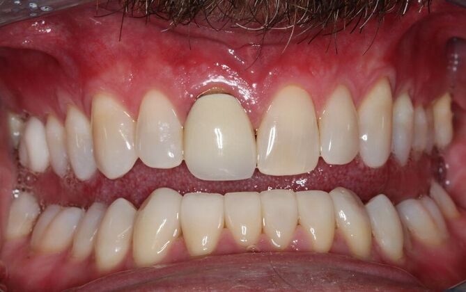 Veneers Case 24 - After