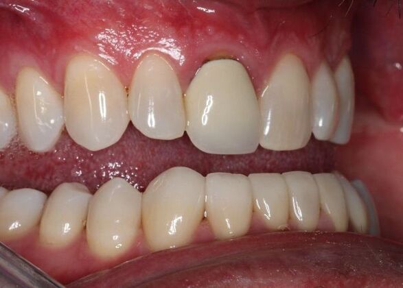 Veneers: Case 24 - After Lower Veneers