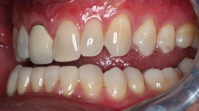 Veneers: Case 24 - After Lower Veneers