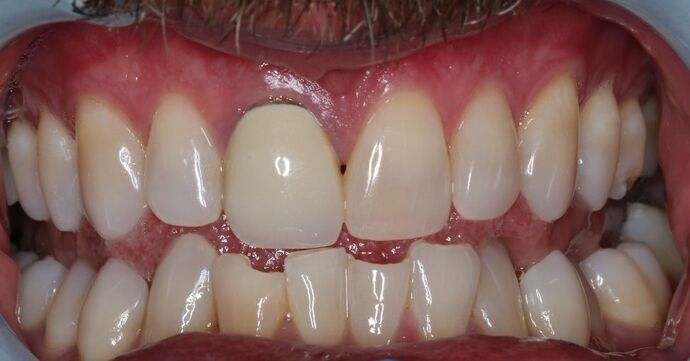 Veneers Case 24 - Before