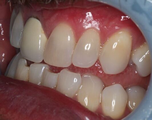 Veneers: Case 24 - Before