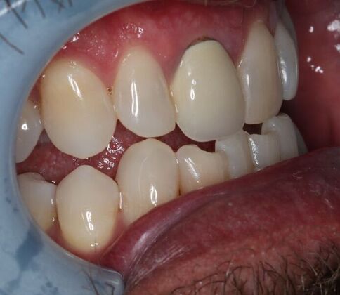 Veneers: Case 24 - Before