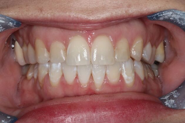 Veneers: Case 25 - Before