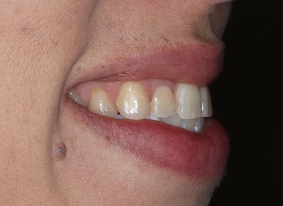 Veneers: Case 25 - Before