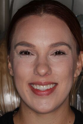 Veneers Case 25 - After