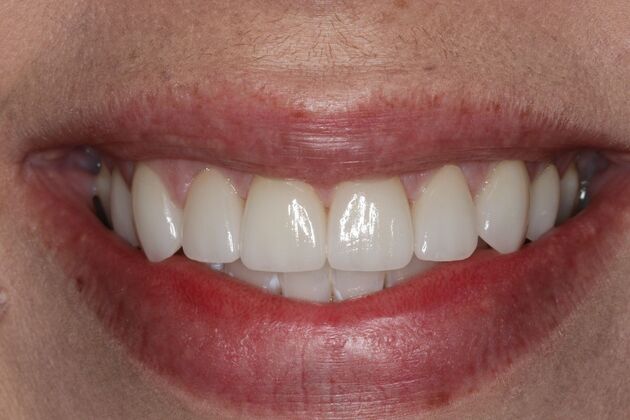 Veneers: Case 25 - After