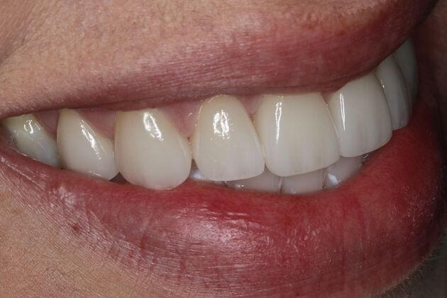 Veneers: Case 25 - After