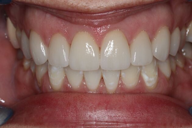 Veneers: Case 25 - After