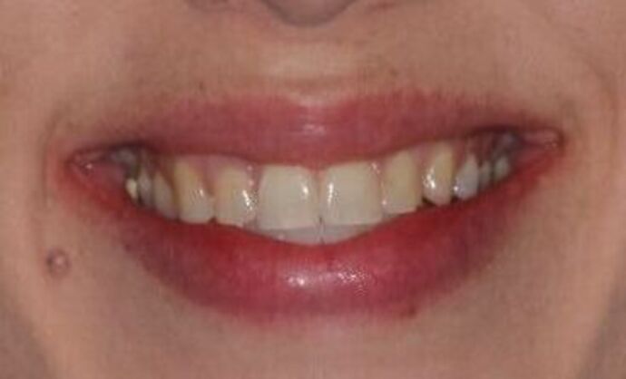 Veneers: Case 25 - Before