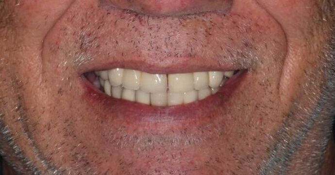 Dental Implants Case 11 - Before