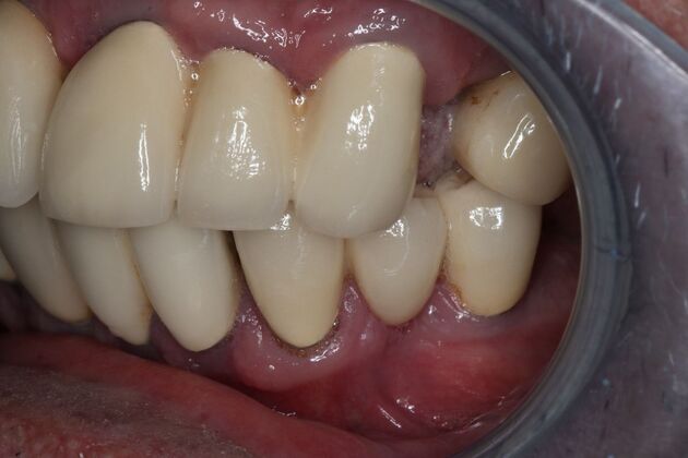 Dental Implants: Case 11 - Before