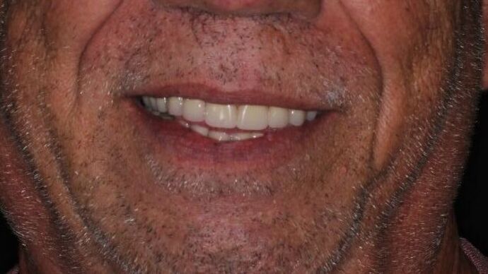 Dental Implants Case 11 - After