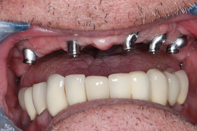 Dental Implants: Case 11 - Implant Abutments