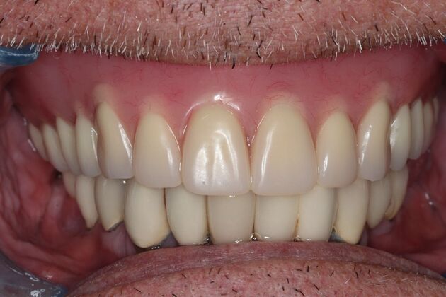 Dental Implants: Case 11 - Upper Overdenture