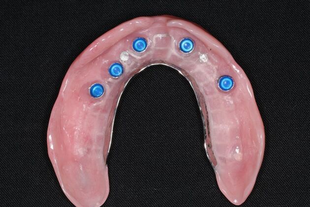 Dental Implants: Case 11 - Inside Overdenture