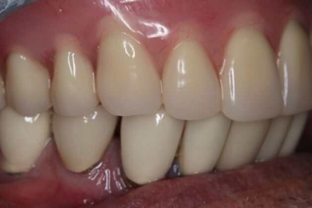 Dentures: Case 14 - Upper Snap Denture