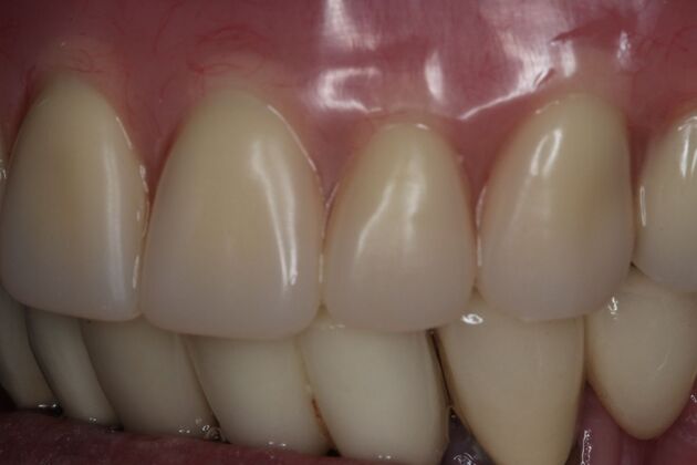 Dentures: Case 14 - Upper Snap Denture