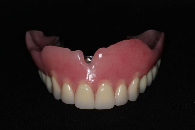 Dentures: Case 14 - Upper Snap Denture