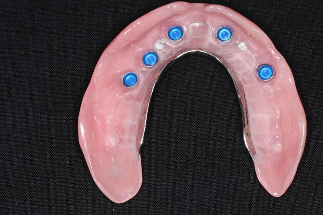 Dentures: Case 14 - Upper Snap Denture