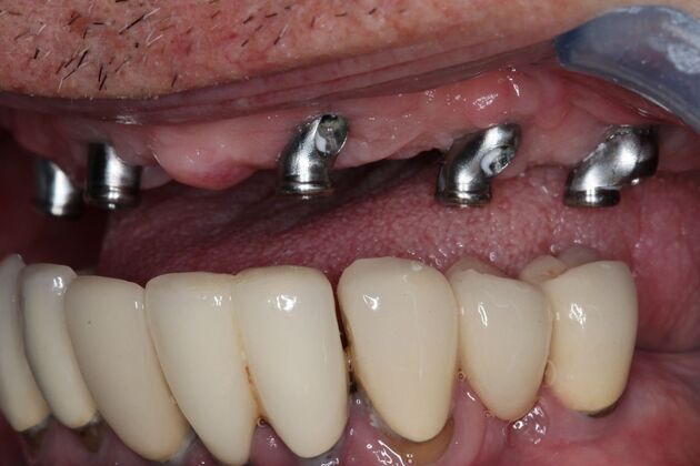 Dentures: Case 14 - Implant Abutments